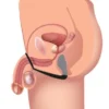 Anillo estimulador de prostata