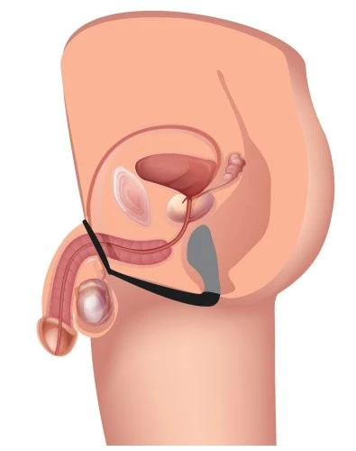 Anillo estimulador de prostata
